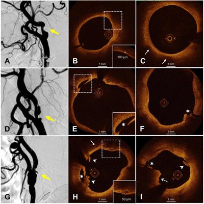 Identification of Symptomatic Carotid Artery Plaque: A Three-Item Scale Combined Angiography With Optical Coherence Tomography